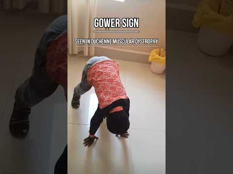 Gowers Sign in Duchenne Muscular Dystrophy